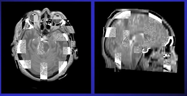 Wynik dopasowania obrazów tomograficznych CT i MR.